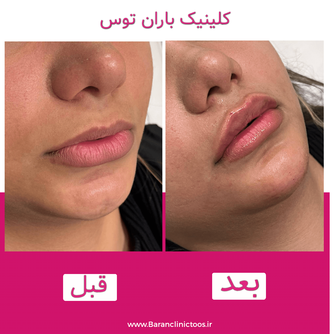 قبل و بعد فیلر لب